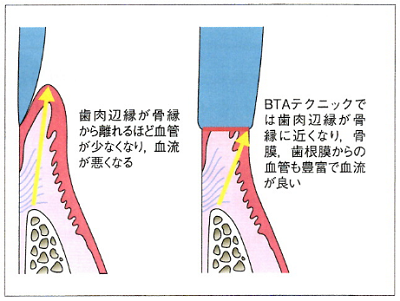 BTAテクニック