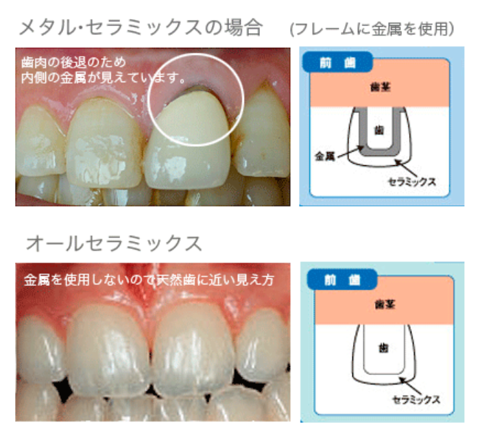 オールセラミック