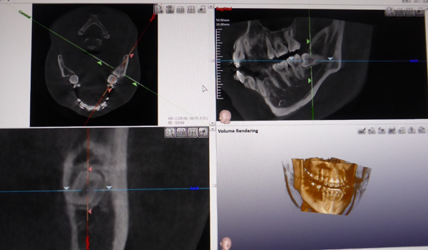 歯科用CT