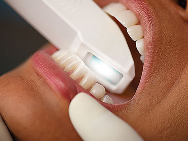 iTero（アイテロ）