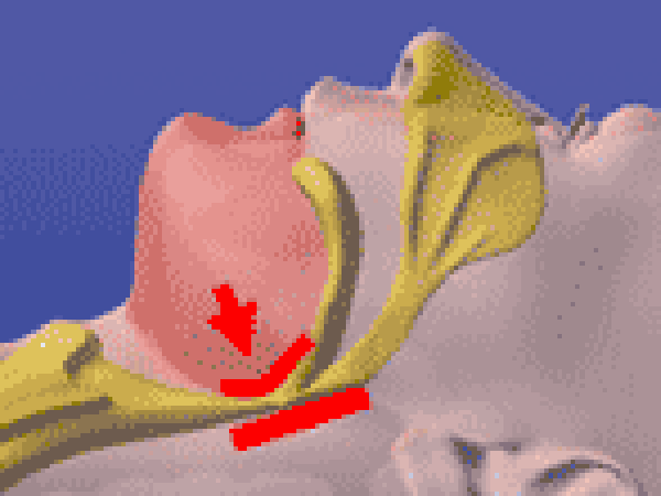 睡眠時無呼吸症候群