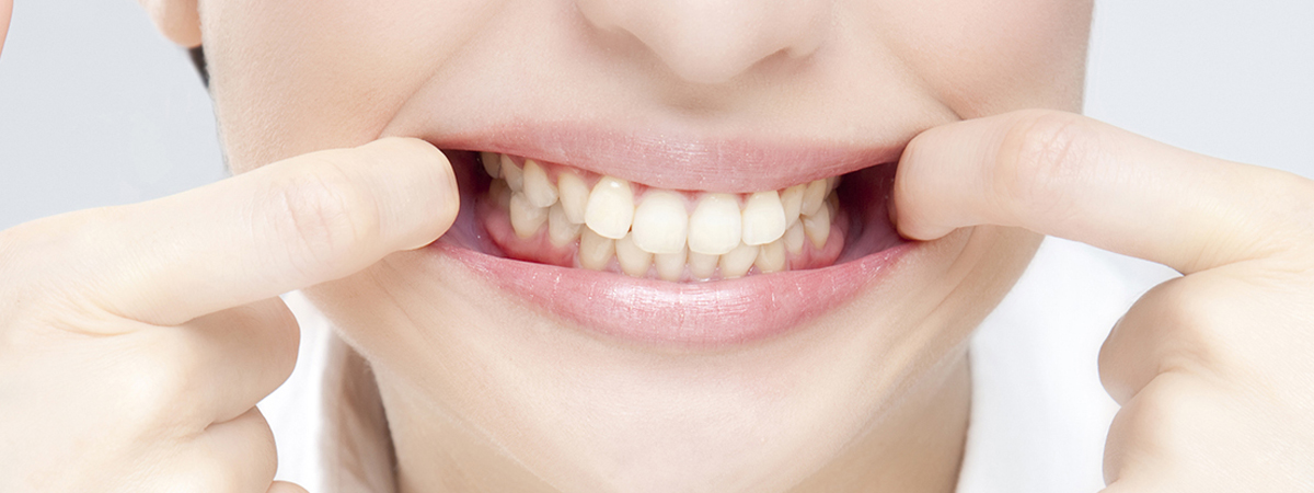 メタルフリー治療