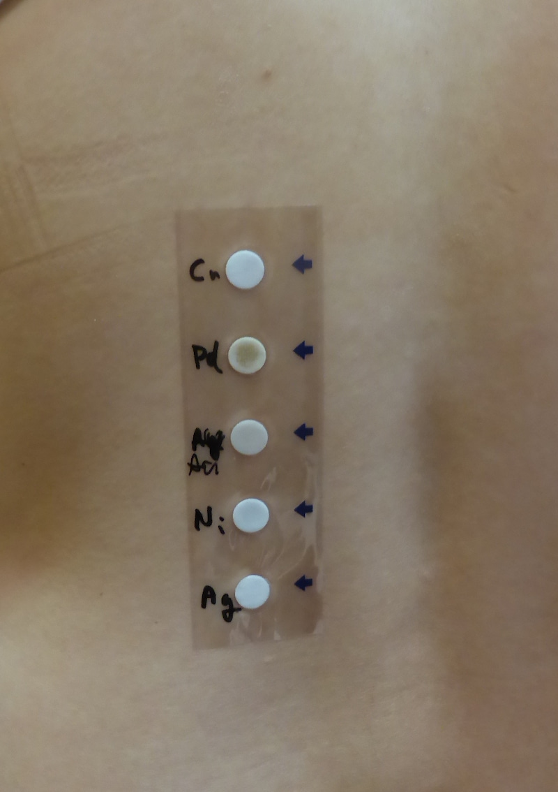 メタルフリー治療