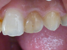 ウォーキングブリーチ